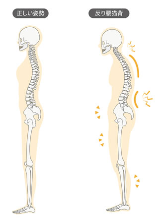 反り腰猫背の人の骨格イラスト|正しい姿勢との比較